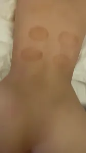 后入极品身材小母狗，刚拔完火罐没两天就被爆操